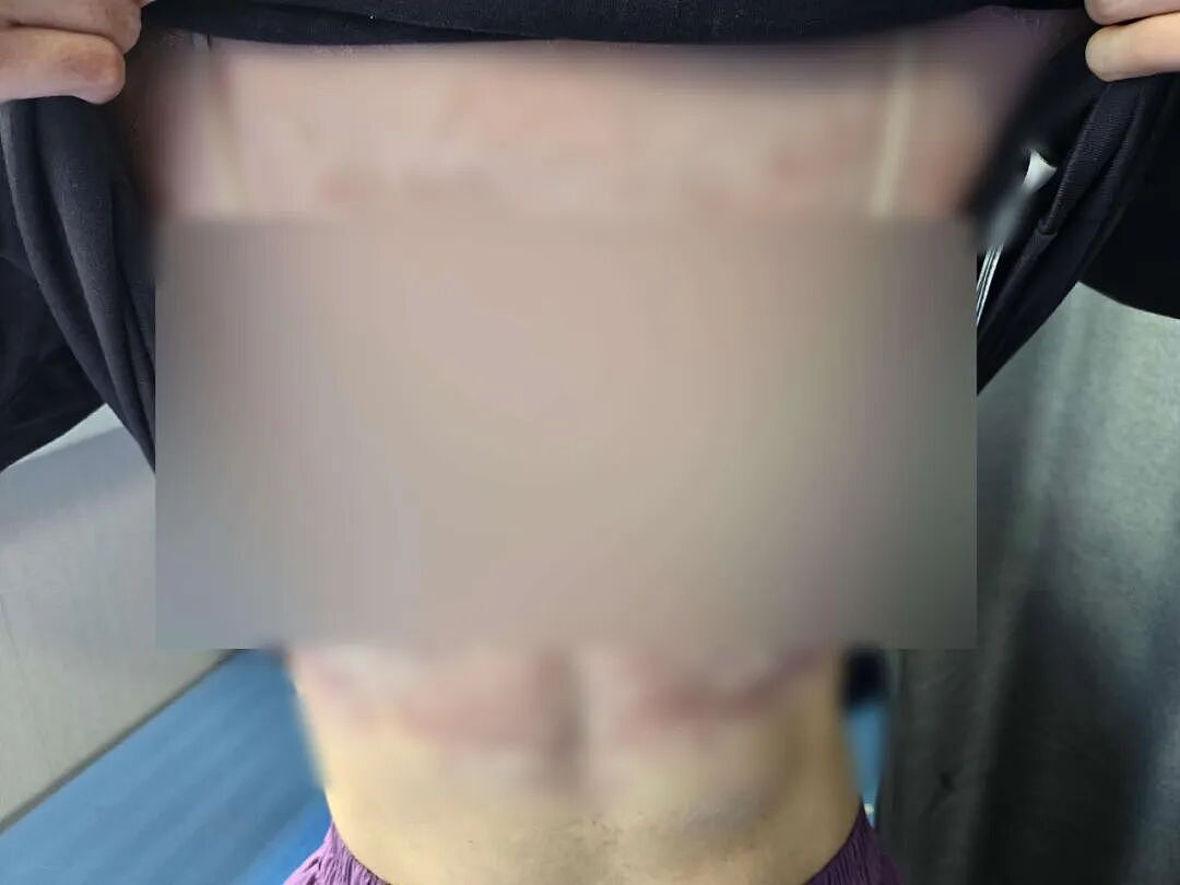 母子相继患“怪病“，红斑爬满全身，整晚煎熬！这件事很多家里都在做，已发现多例（组图） - 1