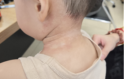 母子相继患“怪病“，红斑爬满全身，整晚煎熬！这件事很多家里都在做，已发现多例（组图） - 2