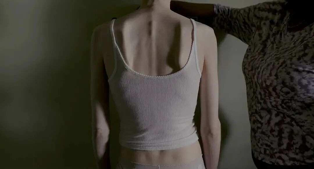 “仙女管”插胃,正毁掉年轻女孩(组图) - 40