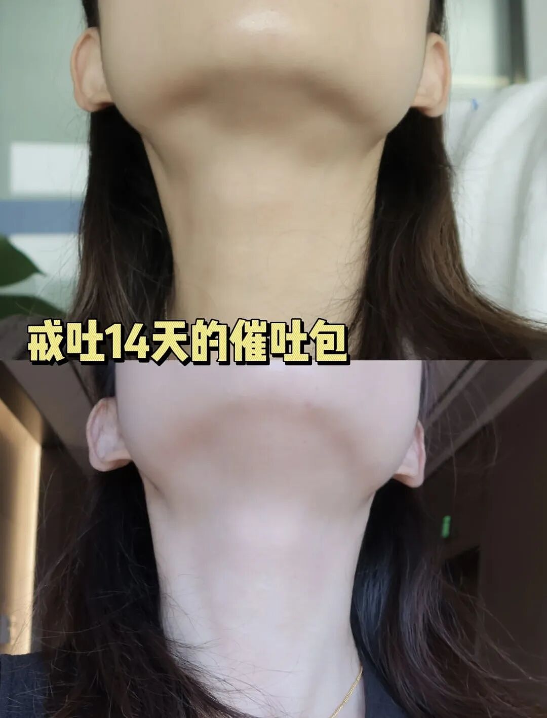 “仙女管”插胃,正毁掉年轻女孩(组图) - 9