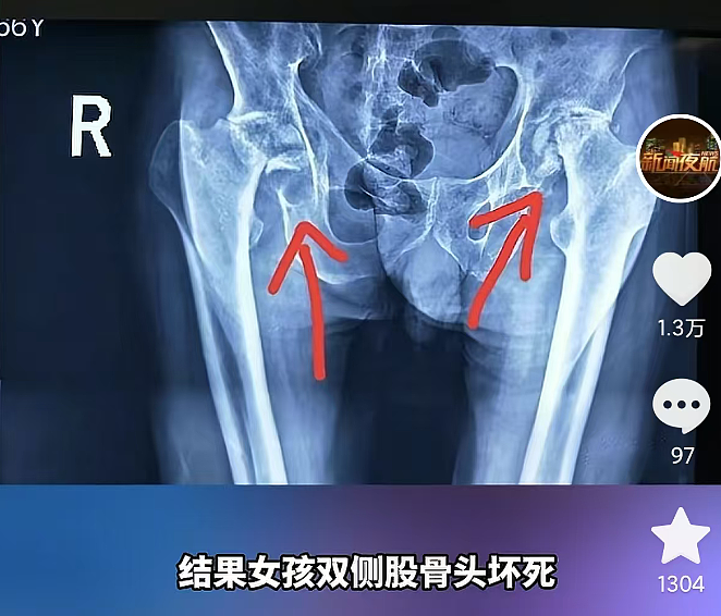 00后男友控制欲爆棚，把激素当 “保健品” 喂女友，害她九级伤残（组图） - 6