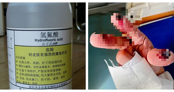 恐怖！女子散步误踩“化骨水”容器，全身骨骼遭侵蚀亡（组图） - 1