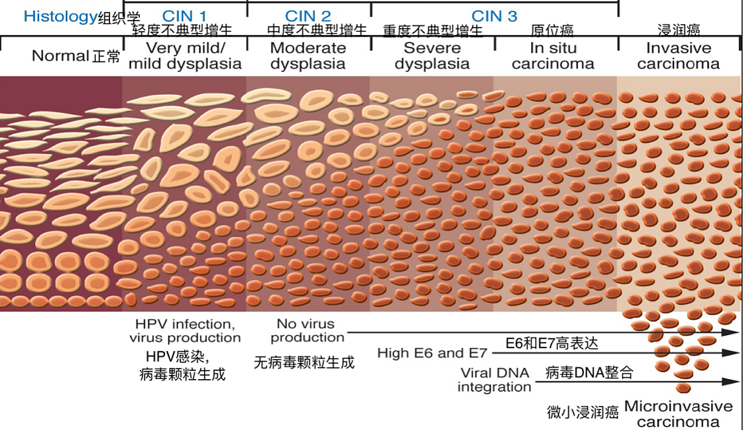 同样感染 HPV，为什么有些人发展为宫颈癌，有些人却没事？（组图） - 1