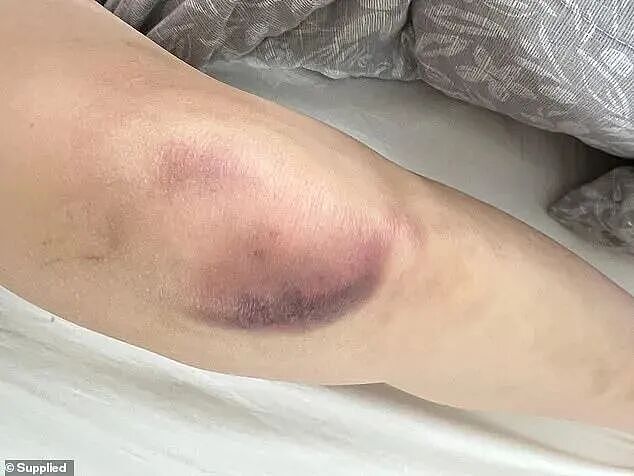 瞳孔地震！澳华裔网红遭华人女子暴打，致面部毁容、四肢淤青！21岁华人女子被捕！真相亮了（组图） - 7