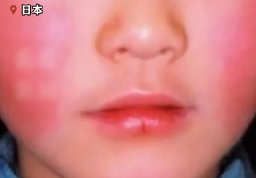 日本“苹果病”大流行，感染人数达历史顶点！孕妇感染或致严重后果（组图） - 2