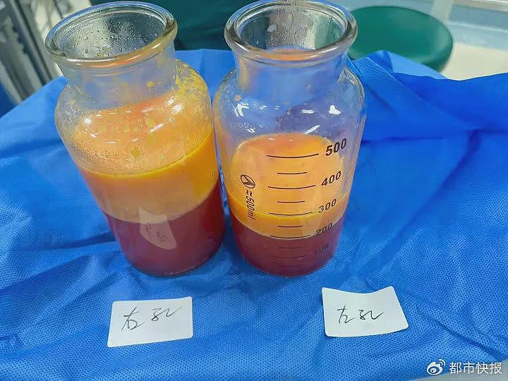 30岁小伙练胸肌练出“A罩杯”,只因做错了一件事(组图) - 2
