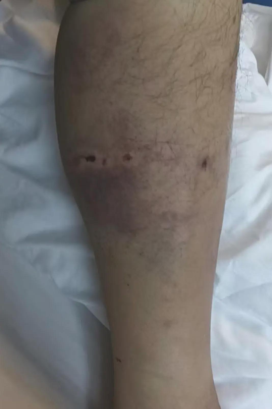 男子上山采菌被黑熊袭击，“被一巴掌扇下悬崖，穿的水鞋救了自己一命”（组图） - 3