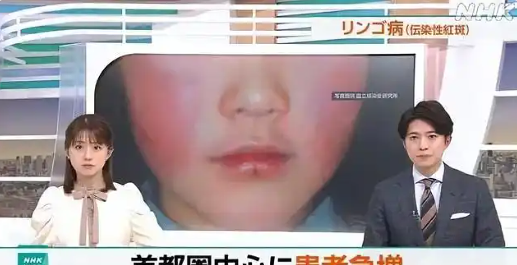 日本“苹果病”大流行，感染人数达历史顶点！孕妇感染或致严重后果（组图） - 1