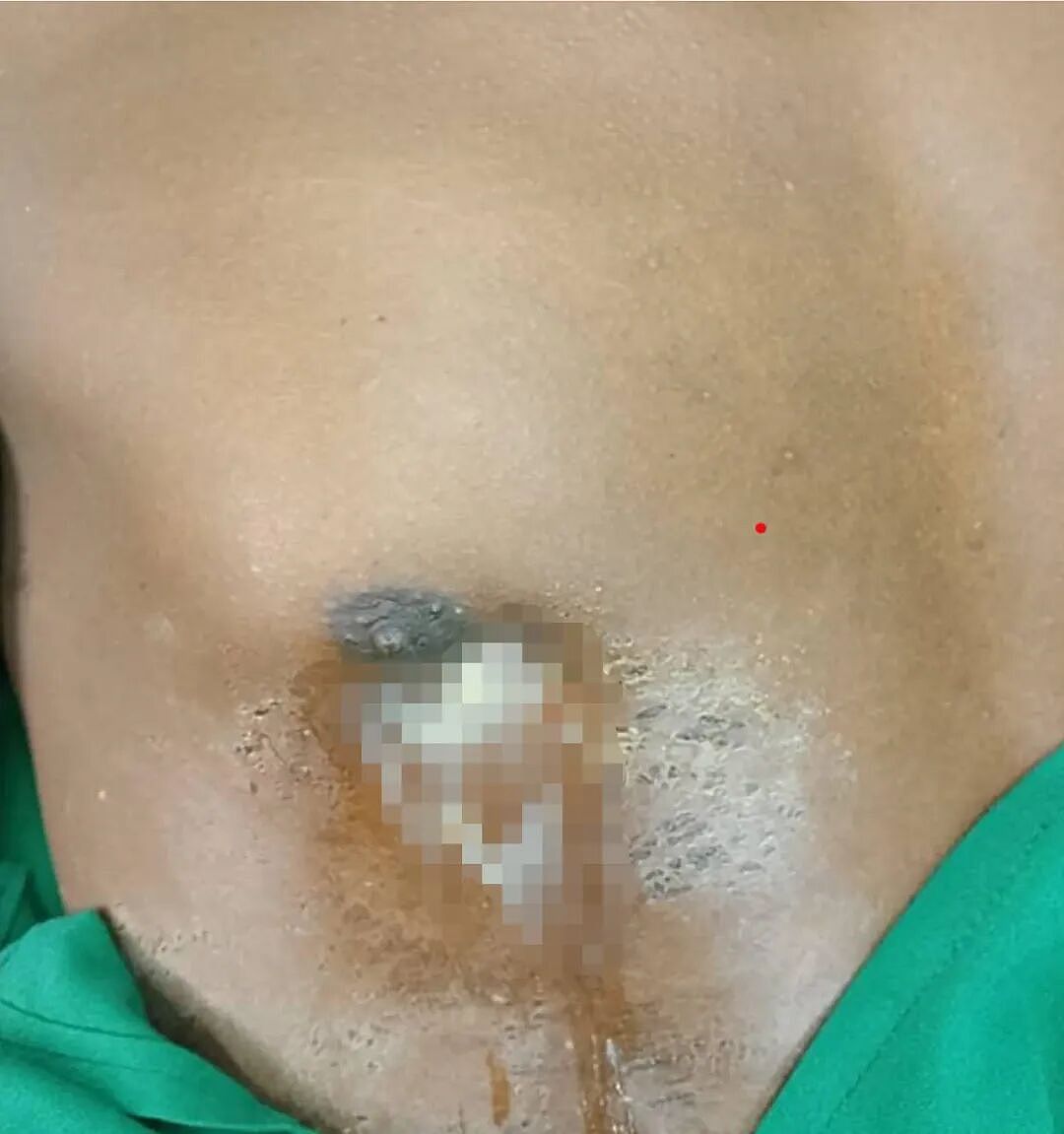 傻眼！男子体内竟插着大刀8年，胸口流脓才发现，医生检查都惊呆了（组图） - 2