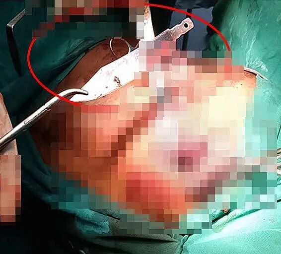 傻眼！男子体内竟插着大刀8年，胸口流脓才发现，医生检查都惊呆了（组图） - 4