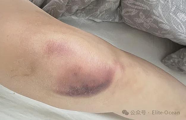 华人热议！中国女网红澳洲餐厅遭暴力殴打，满脸伤痕，全身淤青！网友：自找的，没素质（组图） - 8