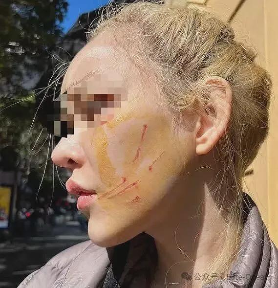 华人热议！中国女网红澳洲餐厅遭暴力殴打，满脸伤痕，全身淤青！网友：自找的，没素质（组图） - 6