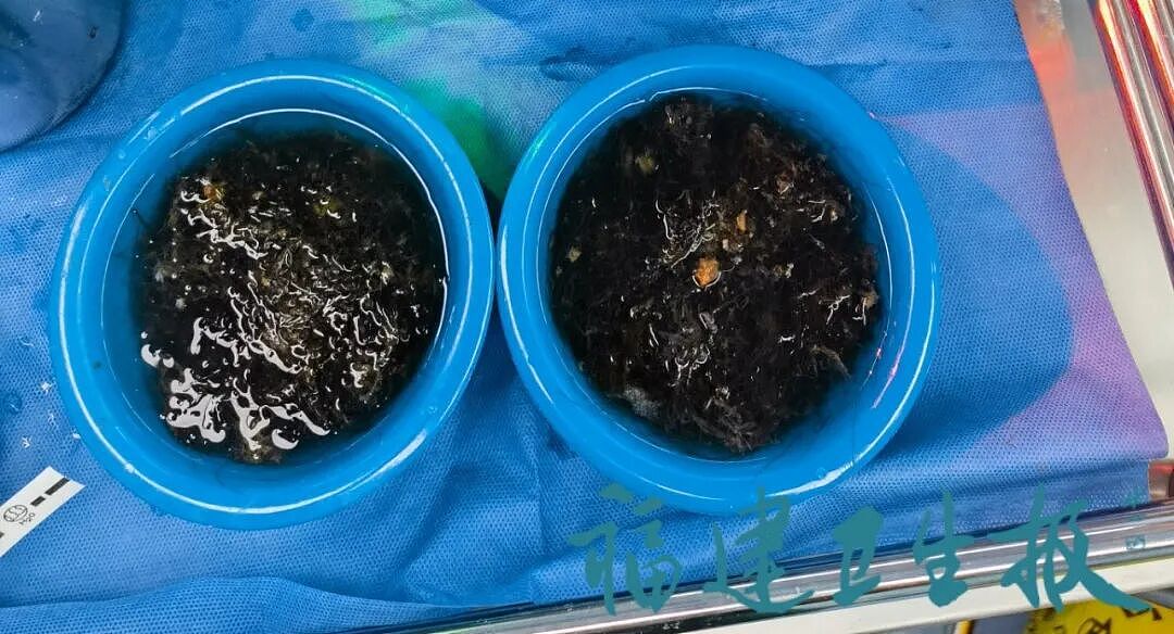 10岁女孩偷偷做这事!体内这一幕让医生惊呆,有人因羞耻感延误就医…(组图) - 2