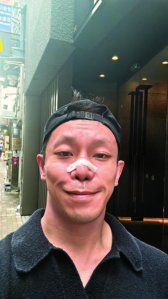 香港富二代遭车祸严重毁容，近照面目全非，曾找十多位医生修复（组图） - 7
