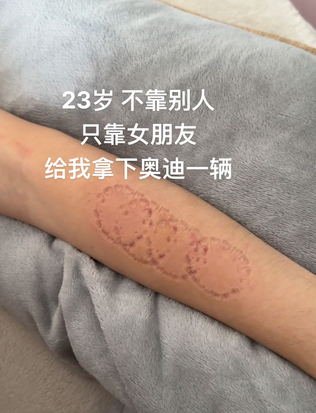 【爆笑】在男朋友身上留下了牙印和红痕！本来想秀恩爱，结果评论区说这明显是别人咬的，因为...（组图） - 2