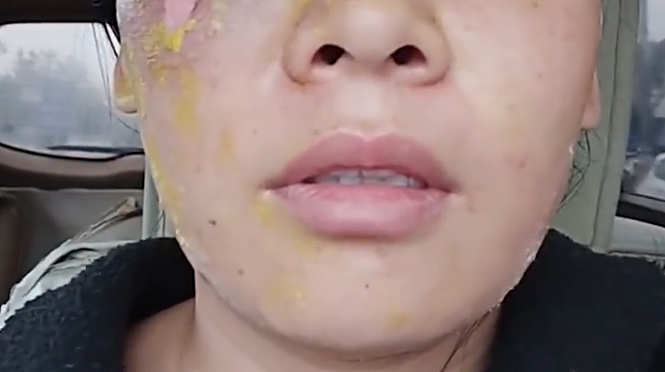 瞬间爆炸，脸被严重烫伤！女子模仿网络“妙招”，白糖加白醋烧开除水垢……（组图） - 1