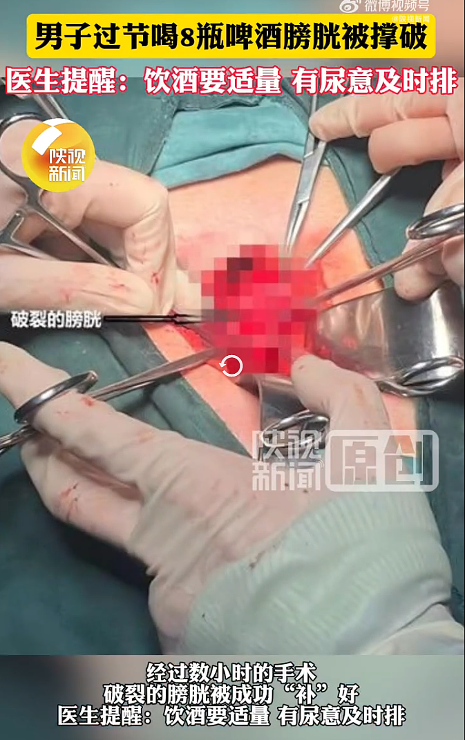 男子豪饮8瓶啤酒，尿意十足却仅有几滴排出，医生：膀胱“炸了”（组图） - 1