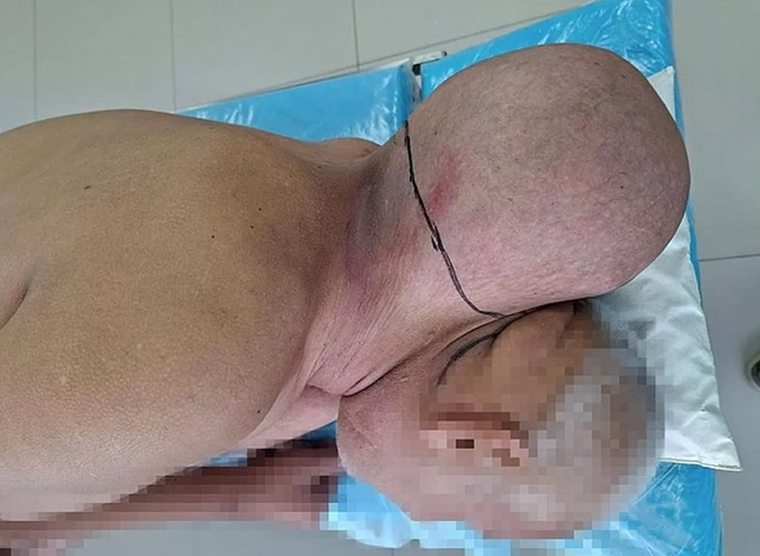 震惊！男子脖子长出第二个“头”，拖了16年才就医…（组图） - 2