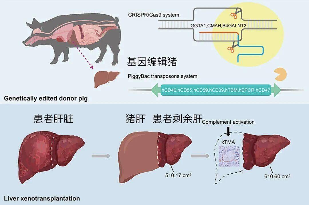 全球首例!中国团队成功将猪肝移植给活人(组图) - 2