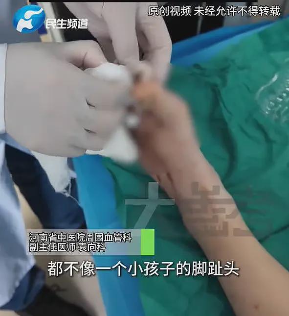 “一天4杯奶茶咖啡，必须全糖”！20岁姑娘患糖尿病，脚趾溃烂险截肢，妈妈：正常的饭她不吃（组图） - 3