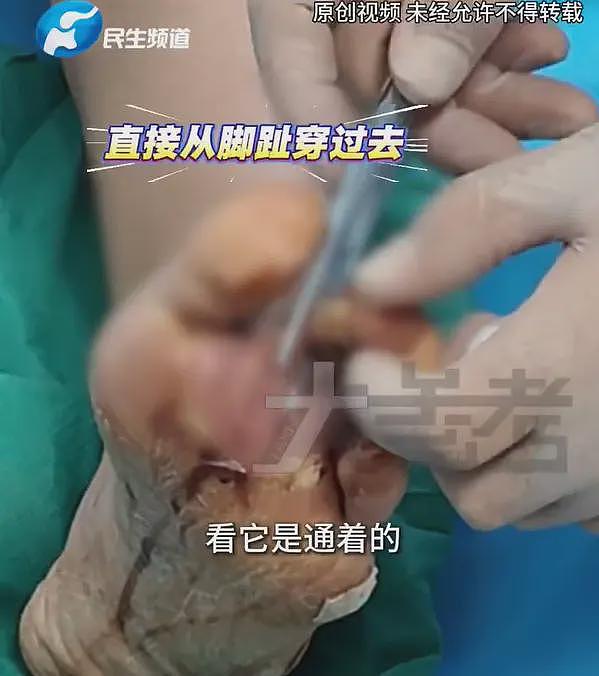 “一天4杯奶茶咖啡，必须全糖”！20岁姑娘患糖尿病，脚趾溃烂险截肢，妈妈：正常的饭她不吃（组图） - 4