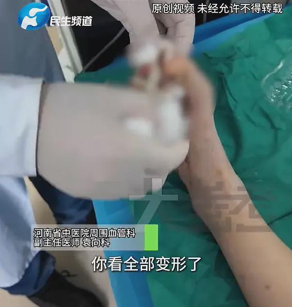 “一天4杯奶茶咖啡，必须全糖”！20岁姑娘患糖尿病，脚趾溃烂险截肢，妈妈：正常的饭她不吃（组图） - 2