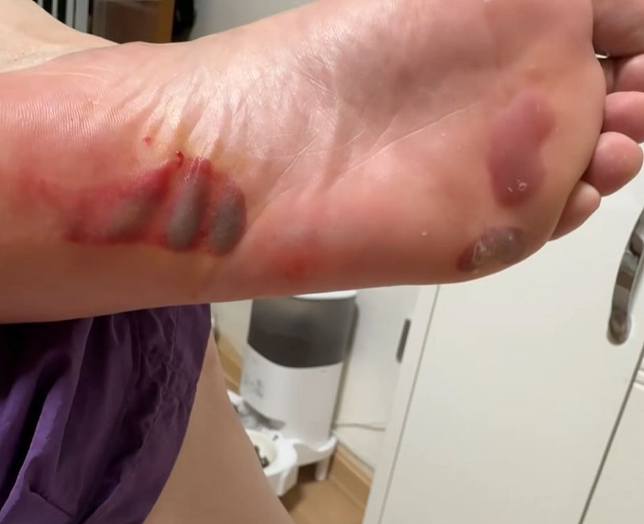 上海女子突然脚底喷血,紧急送医!这东西很多人在用,有人称“一个月瘦20斤”…(视频/组图) - 9