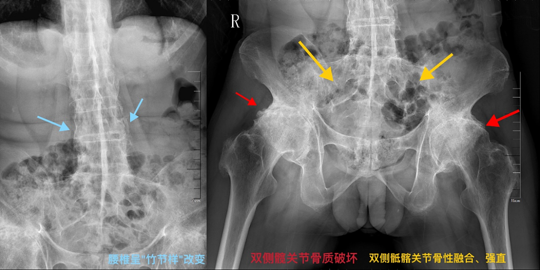 顶流男歌手,确诊超20年!医生提醒:这种症状极易误诊(组图) - 4
