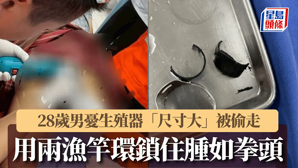 泰男忧“尺寸太大”被偷,竟用两环锁住生殖器,肿成拳头急送院(组图) - 1