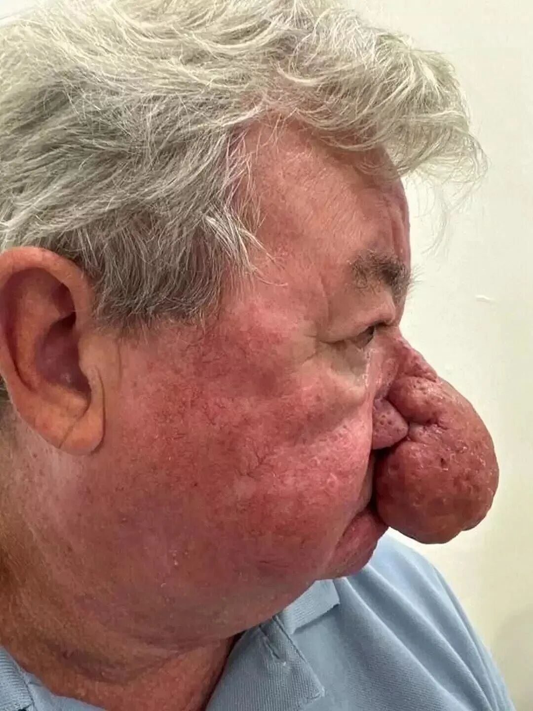 老头得巨大酒渣鼻，半张脸都是鼻子，嘴都看不见！割完他终于爽了（组图） - 1