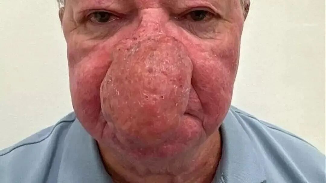 老头得巨大酒渣鼻，半张脸都是鼻子，嘴都看不见！割完他终于爽了（组图） - 2