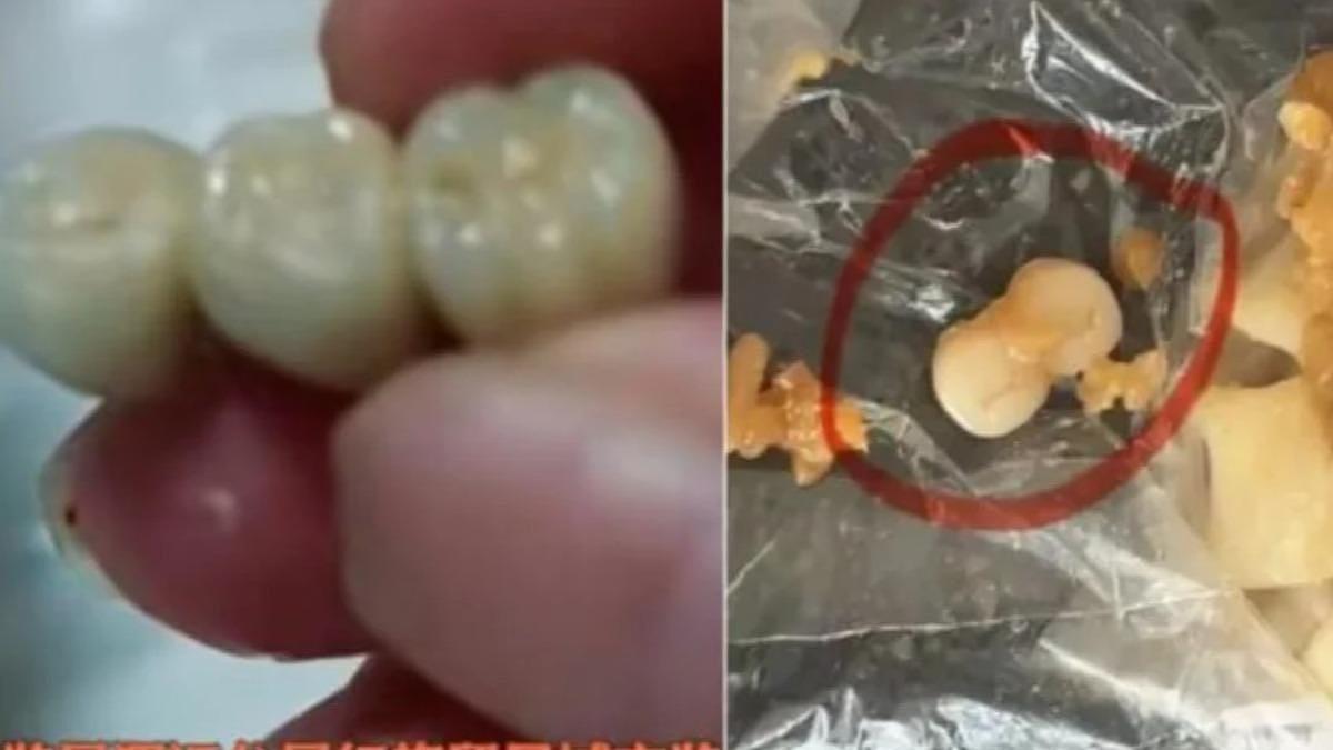 人肉叉烧包？中国女子吃香肠竟咬出3颗牙齿（图） - 1