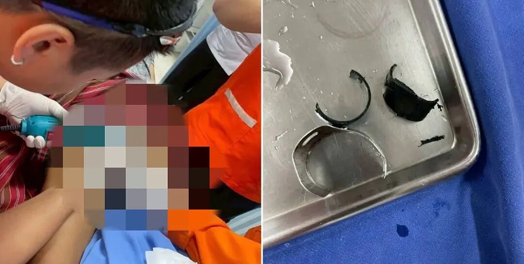男子担心自己丁丁太大被偷,出奇招用钢圈套上,结果取不出来了...(组图) - 3