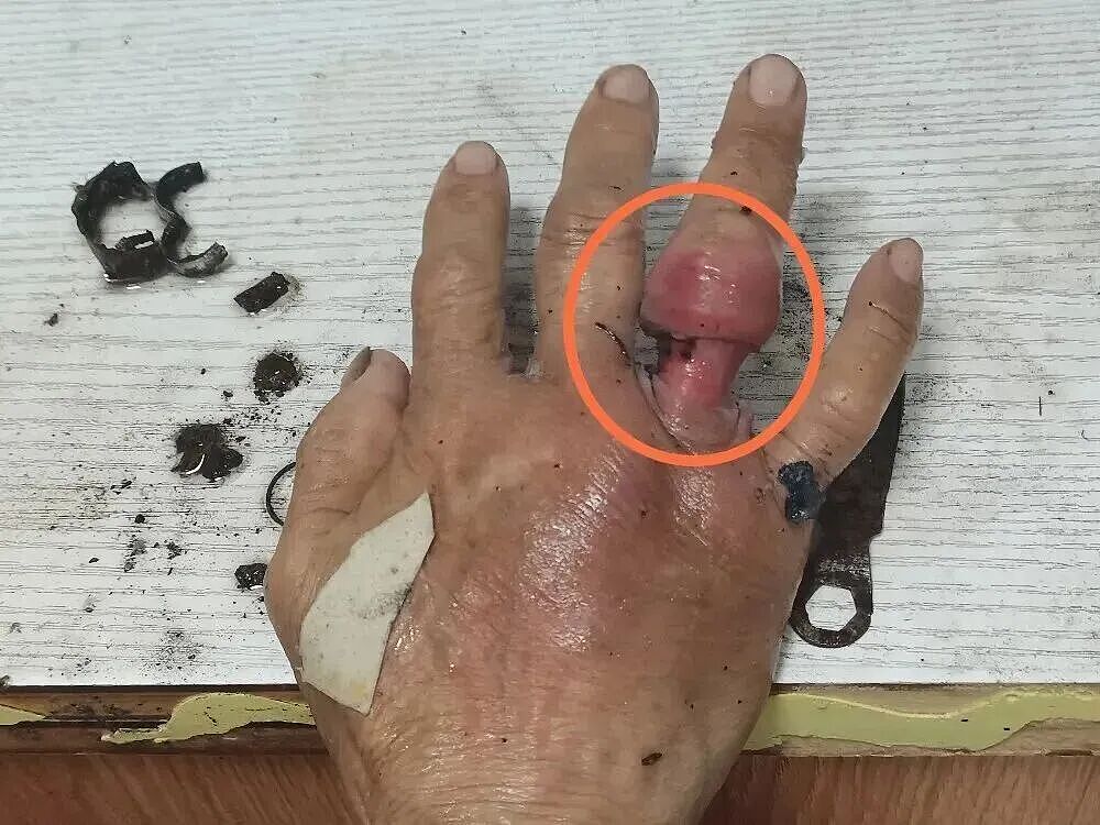 肿成“萝卜手” ！多年“老友”让老人手指充血化脓，儿子：根本劝不听...（组图） - 4