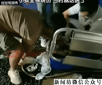 3岁男童不慎掉进炭火堆，全身85%烧伤，母亲徒手救出！网友：光看就疼得不行！父母发声（视频/组图） - 2