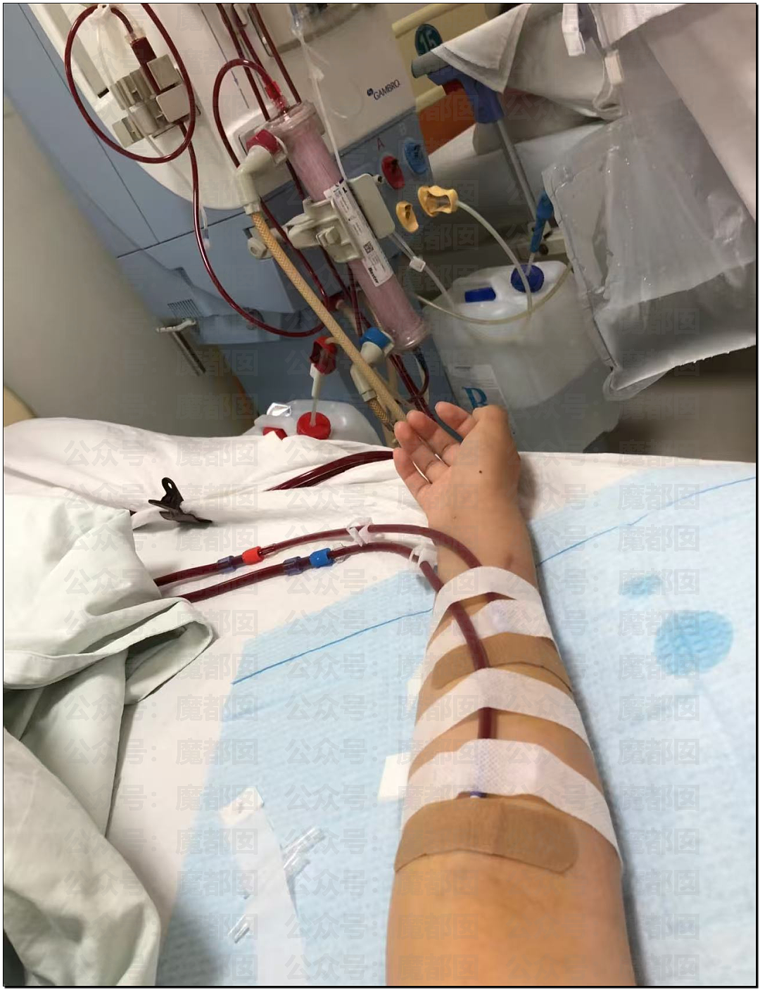 男生无节制每月频繁擦拭管道20余次突发尿血肾衰送ICU（视频/组图） - 3