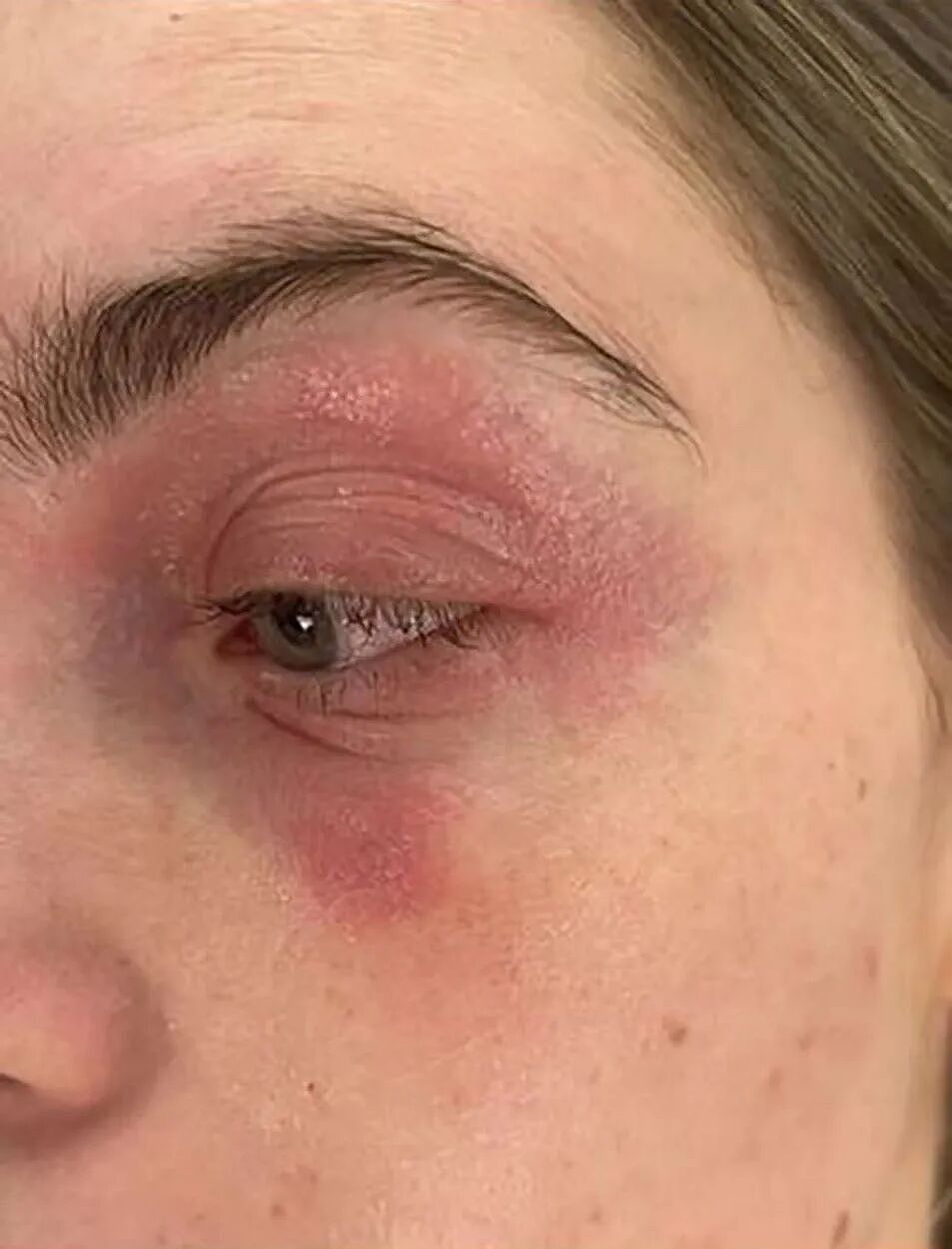 妹子莫名其妙病了6个月，一直找不到原因，直到她无意中摘下了耳朵上的劣质耳环...（组图） - 3