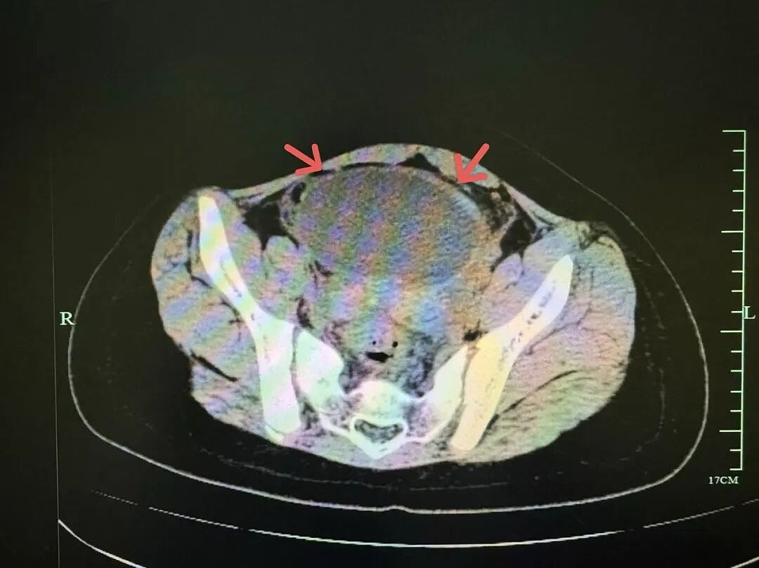 太可怕！10岁女孩差点失去卵巢，极易被误诊，这种情况家长需马上送医（组图） - 2