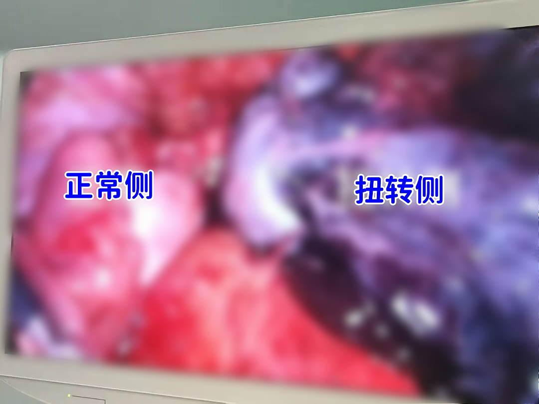 太可怕！10岁女孩差点失去卵巢，极易被误诊，这种情况家长需马上送医（组图） - 3