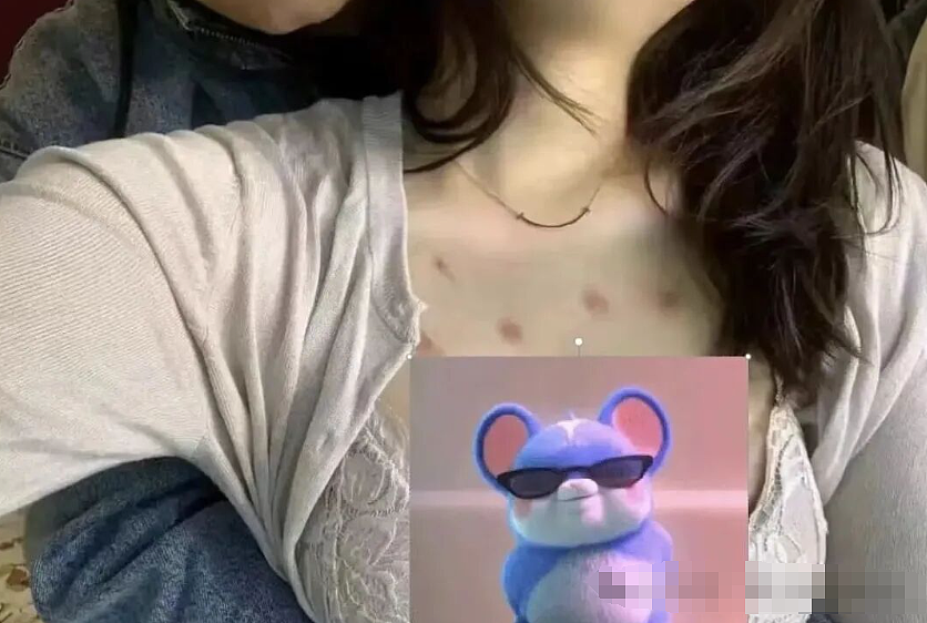 美女骑手染梅毒又传给3男,网传胸口多处斑点照太吓人…(组图) - 1