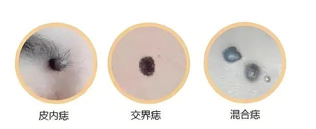 确诊癌症！男子一颗痣长了20年，一直没重视，医生紧急提醒（组图） - 1