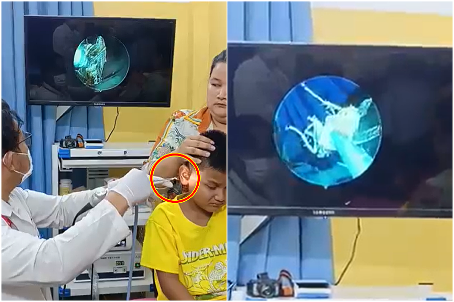 男童耳朵痛！竟夹出“整只活蟑螂”还在动，恐怖过程曝光（视频/图） - 1