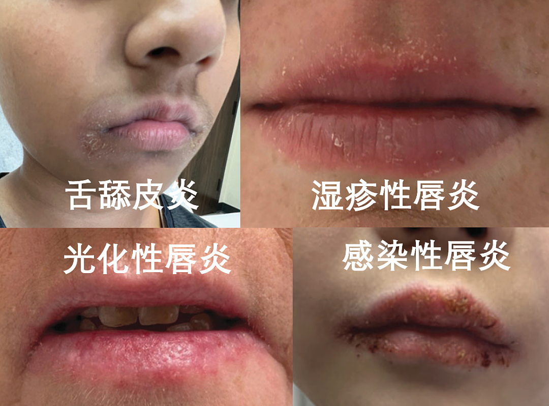 嘴唇总是干裂、起皮,可能不是“水喝少了”,而是得了这种病(组图) - 4