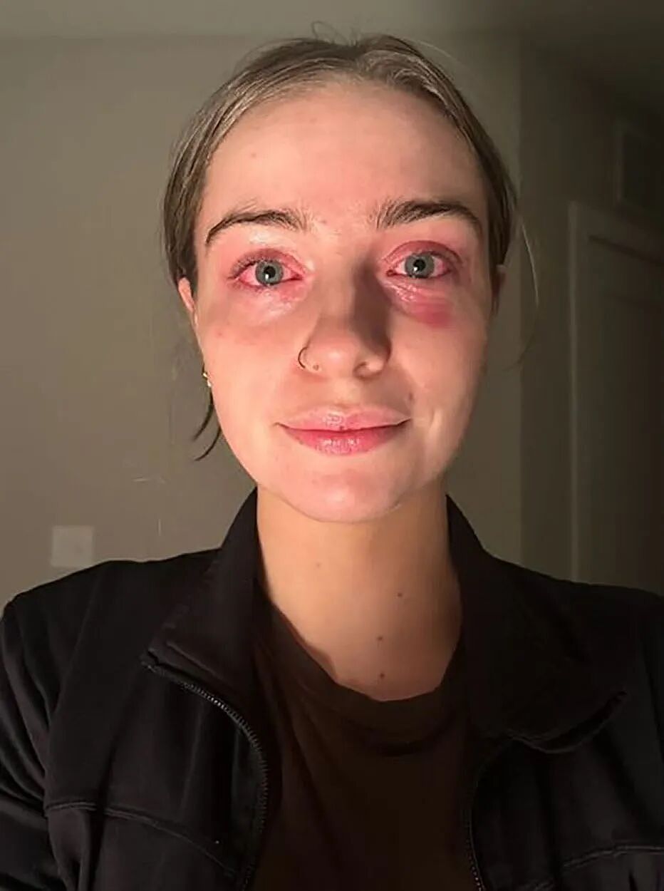 妹子莫名其妙病了6个月，一直找不到原因，直到她无意中摘下了耳朵上的劣质耳环...（组图） - 6