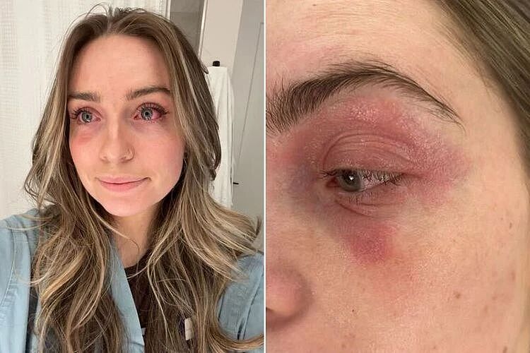 妹子莫名其妙病了6个月，一直找不到原因，直到她无意中摘下了耳朵上的劣质耳环...（组图） - 5