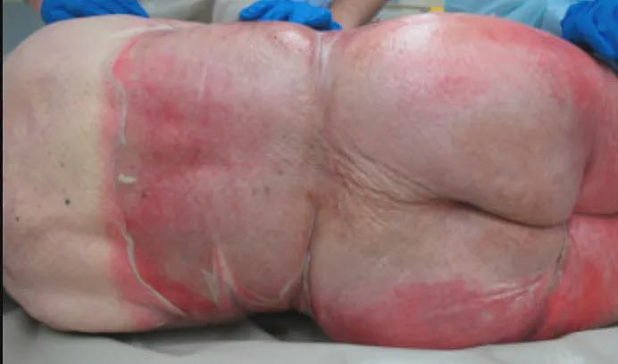 男子酒店洗澡被活活烫死！58℃热水如“烫猪皮”，瞬间皮开肉绽！家属崩溃...（组图） - 5