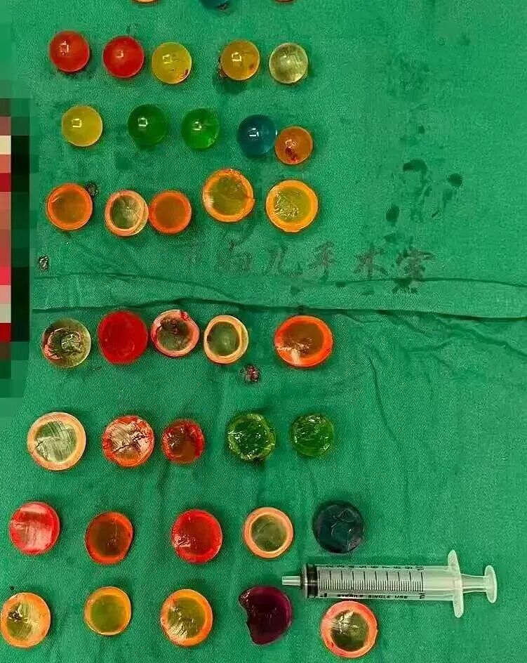 膀胱要“炸”了!14岁少年做B超震惊医生!整整38颗……重要提醒(组图) - 2