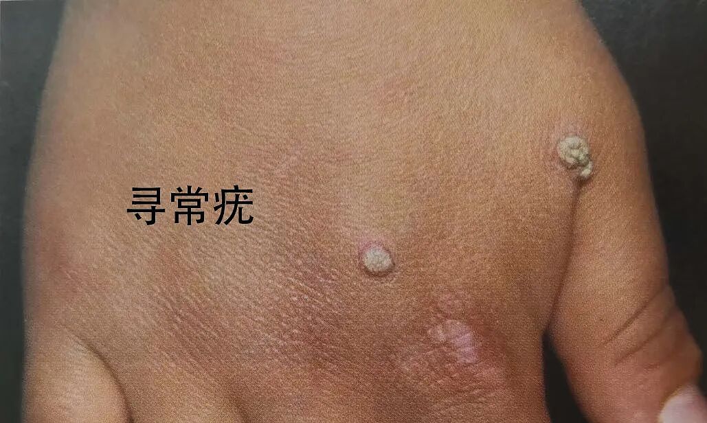 皮肤上这些小疙瘩，跟HPV感染有关（组图） - 3