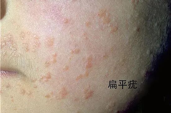 皮肤上这些小疙瘩，跟HPV感染有关（组图） - 6