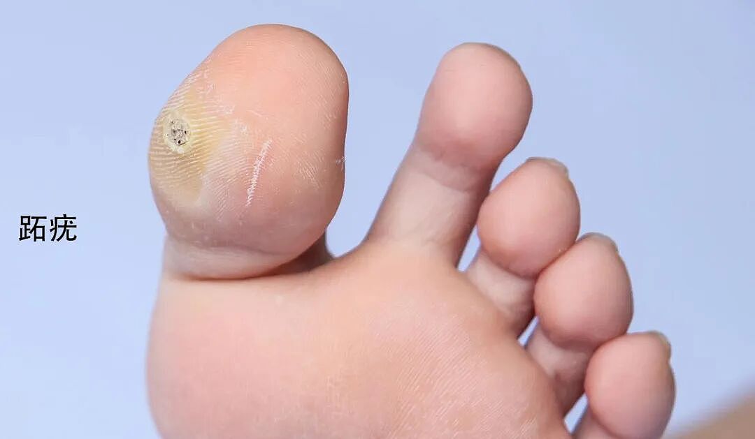 皮肤上这些小疙瘩，跟HPV感染有关（组图） - 5